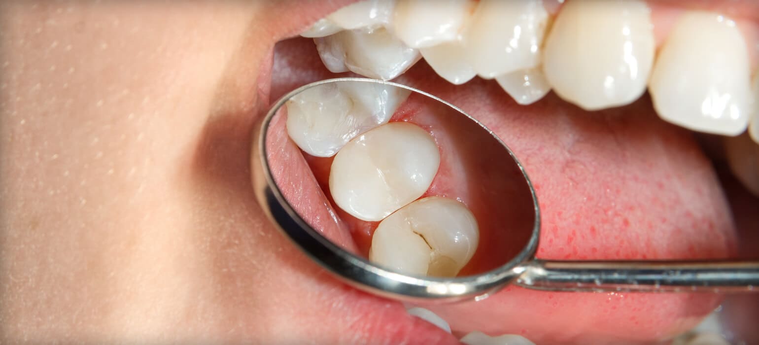 showing teeth with dental mirror