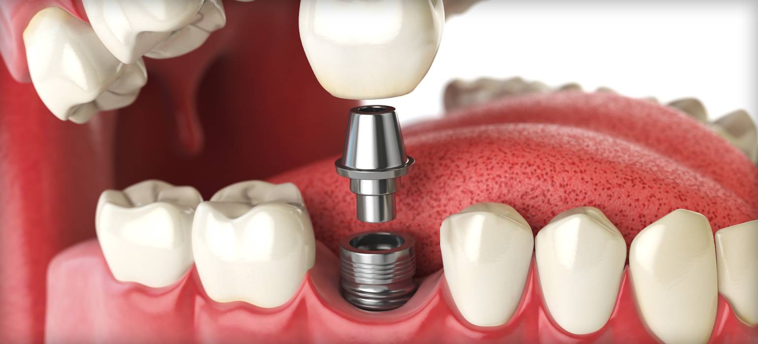 Ourservices Implants tooth implant