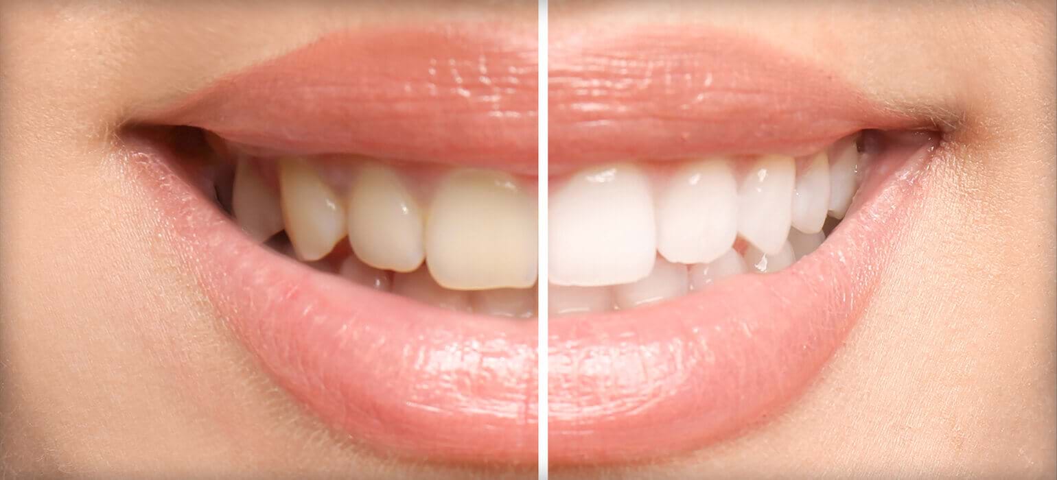 before and after of smile