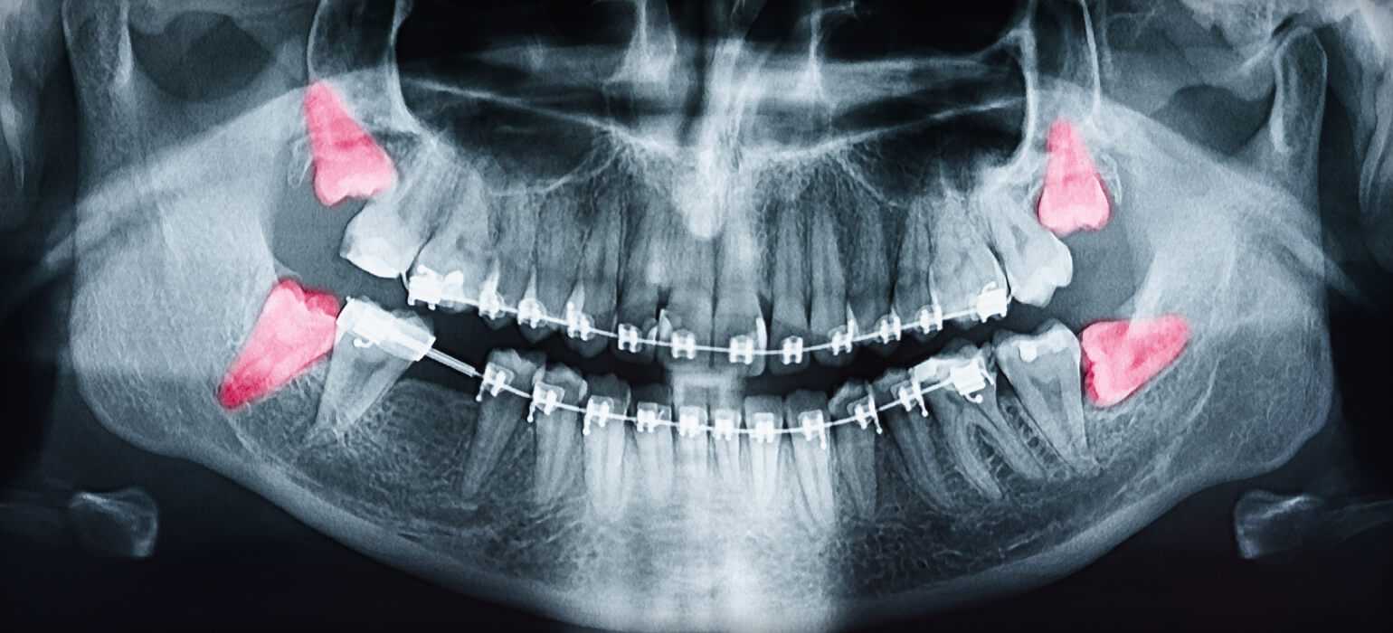 Xray showing wisdom teeth coming in