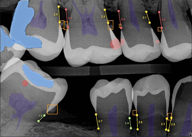 Overjet xray