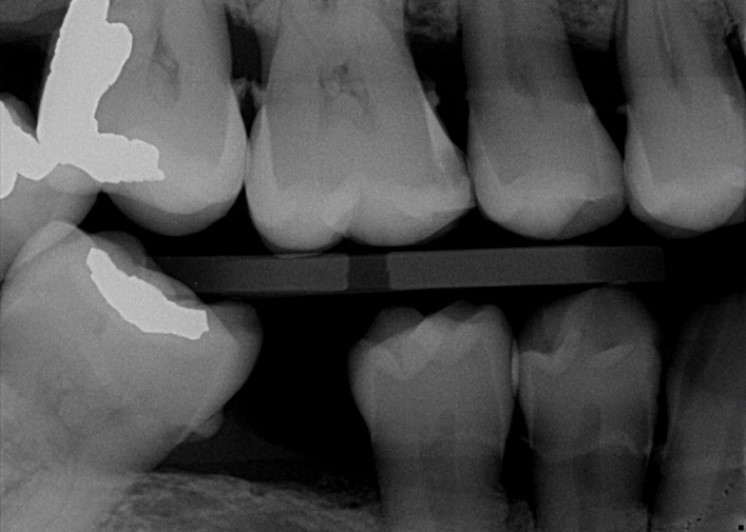 Xray